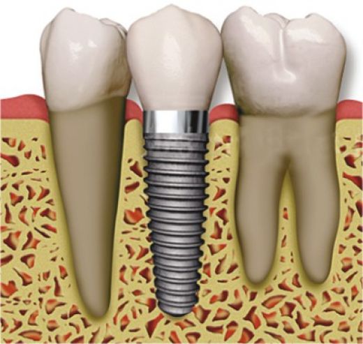 What To Expect When You Have A Dental Implant Procedure