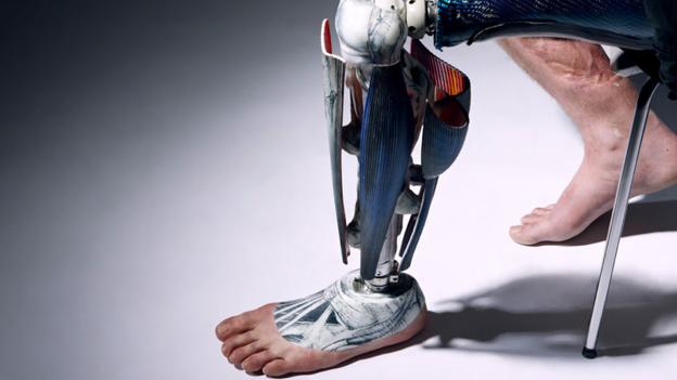 Regain Your Lost Strength: Prosthetic Limbs