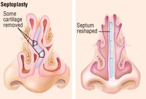6 Signs You May Have A Deviated Septum