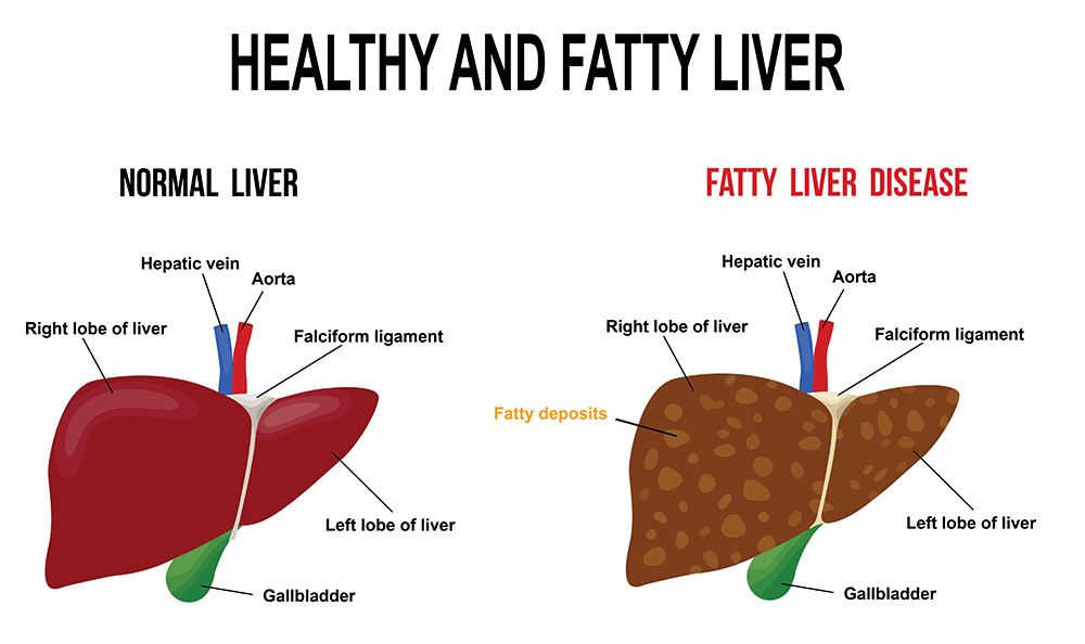 food for fatty liver