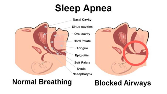 how to cure sleep apnea 